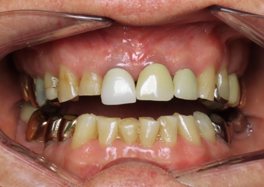 Young man in Grand Island with gapped teeth