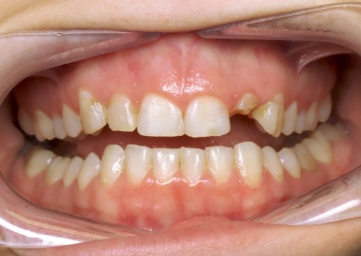 Young man in Grand Island with gapped teeth