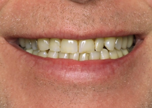 Young man with a chipped tooth before dental treatment in Grand Island