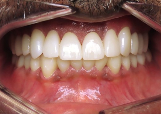 Smiling Grand Island woman with perfectly aligned teeth