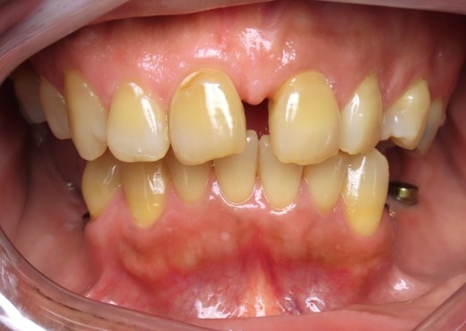 Young man in Grand Island with gapped teeth