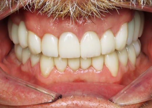 Young man with well aligned teeth thanks to dentist in Grand Island