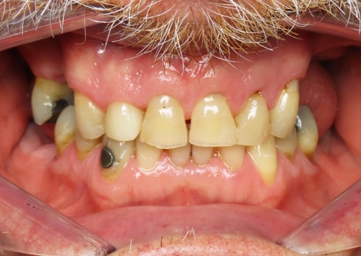 Young man in Grand Island with gapped teeth