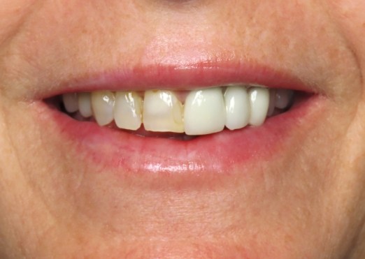 Young man in Grand Island with gapped teeth