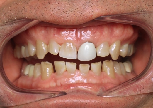 Young man in Grand Island with gapped teeth