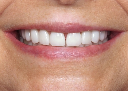 Young man with well aligned teeth thanks to dentist in Grand Island