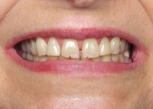 Young man in Grand Island with gapped teeth