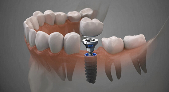 a 3D illustration of a dental implant various parts