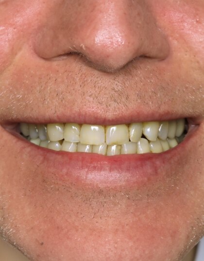 Young man with a chipped tooth before dental treatment in Grand Island