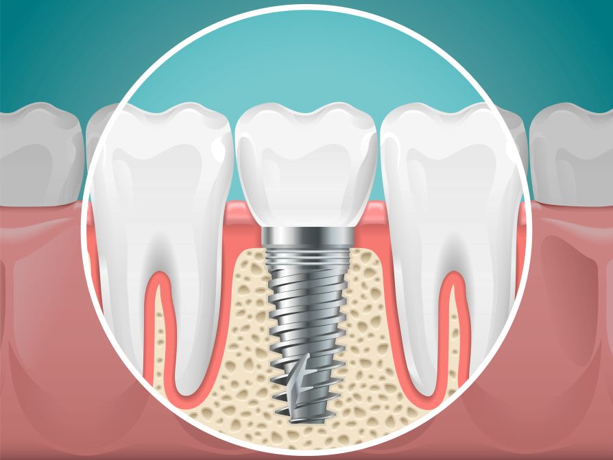 A computer-generated drawing of a dental implant placed in a jaw.